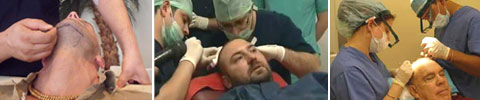 Türkei Haartransplantation